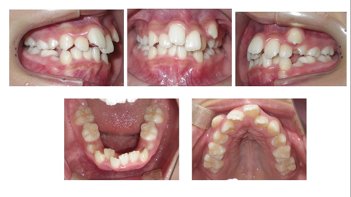 矯正症例75　叢生を伴う骨格性下顎前突