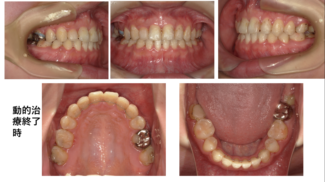 矯正症例142、AngleⅠ級、上顎前突
