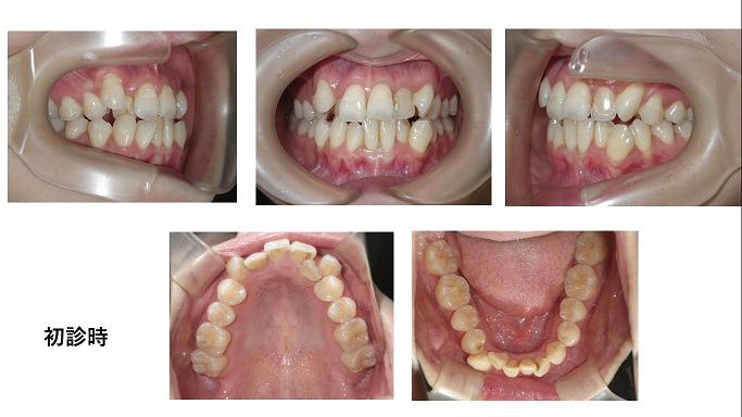 矯正症例96 下顎前突傾向を伴う AngleⅠ級叢生、能代市、秋田市、北秋田市、大館市
