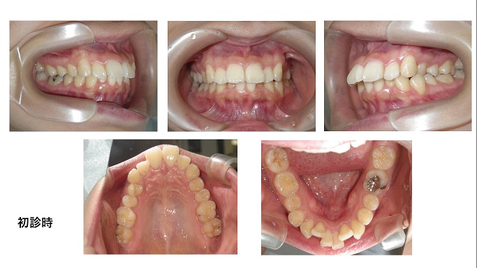 矯正症例92　AngleⅠ級歯槽性上下顎前突　