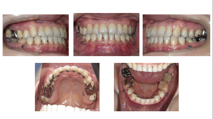 矯正症例51　下顎前突　叢生　能代市　北秋田市　大館市　