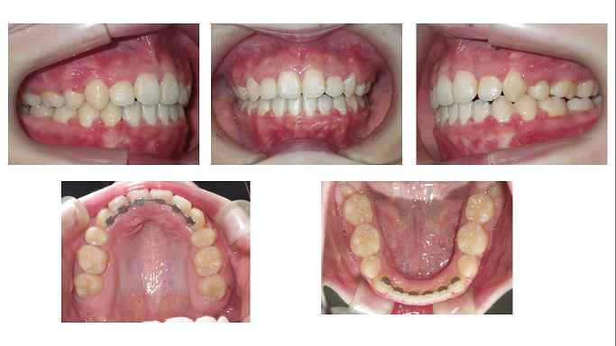矯正症例64 Angle class Ⅱ 上顎前突 叢生 出っ歯 能代市 北秋田市  大館市 歯列矯正