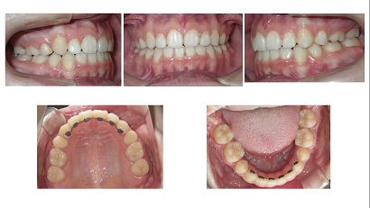 矯正症例53　叢生　デコボコ　秋田市　能代市　北秋田市　大館市