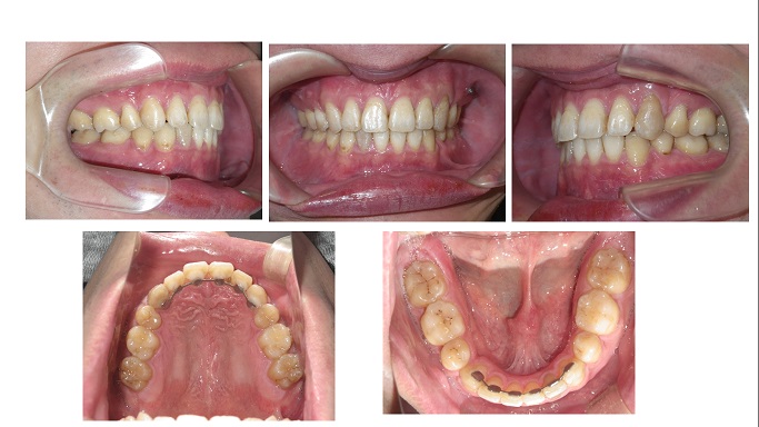 矯正症例62上下顎前突