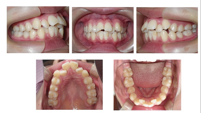 矯正症例67　Angle1級上顎前突　出っ歯