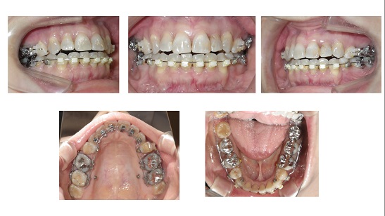矯正症例55 舌側矯正 ハーフリンガル