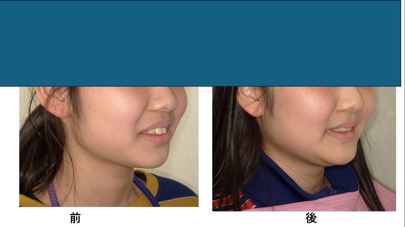 矯正症例149　AngleⅠ級上顎前突