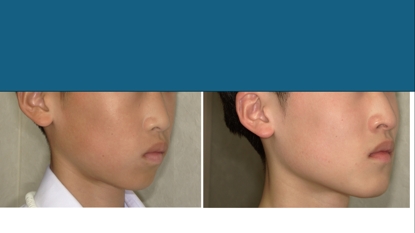 矯正症例148　AngleⅠ級上顎前突、裏側矯正、舌側矯正