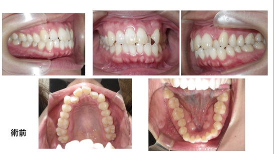 矯正症例81　上下顎前突　裏側矯正 舌側矯正 能代市　北秋田市　大館市　秋田市