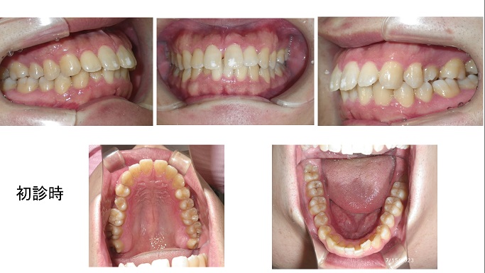 矯正症例９０　AngleⅠ級上下顎前突　能代市、秋田市、北秋田市、潟上市、大館市