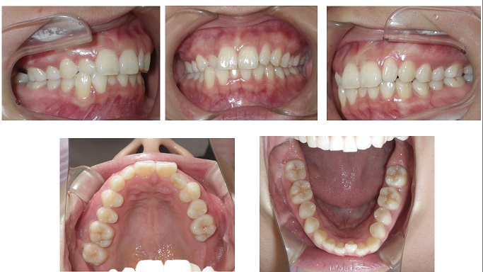 矯正症例69　上顎左側犬歯の先天性欠如を伴う Angle Ⅱ級叢生