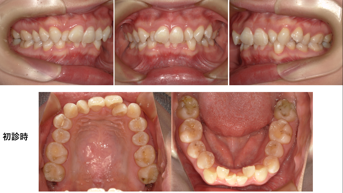 矯正症例144 AngleⅡ級2類