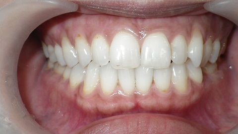 ホワイトニングした後、歯茎の黒ずみ（メラニン）除去です。