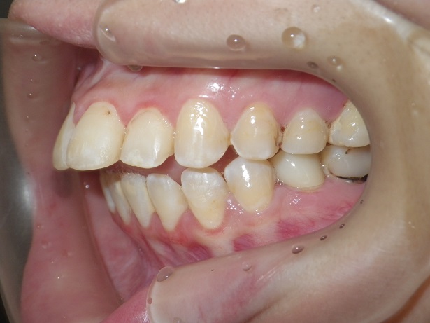 インチキデタラメ矯正3、非抜歯拡大矯正