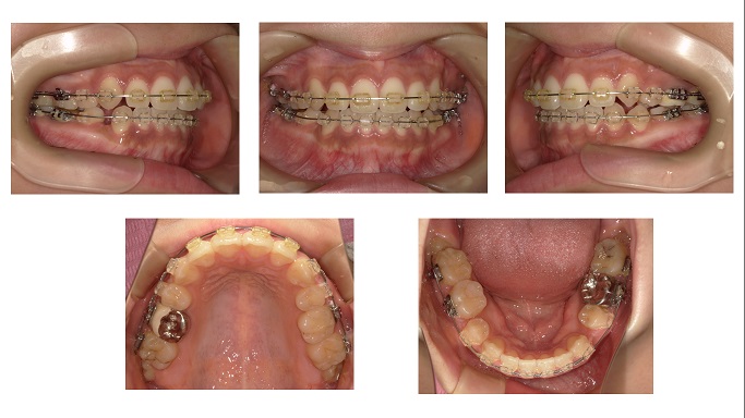 歯列矯正のセカンドオピニオン症例、基地外歯科医