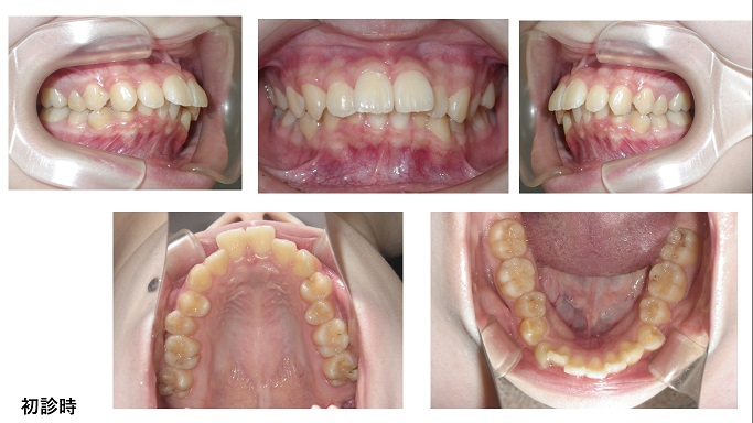 矯正症例88　上下顎前突　秋田市、潟上市、能代市、北秋田市、大館市
