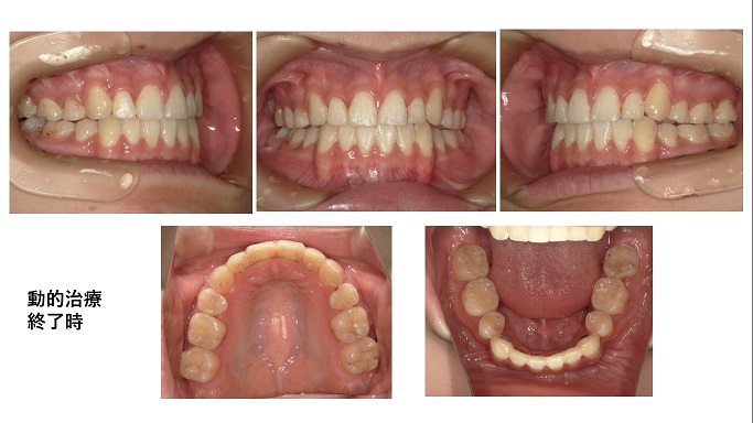 矯正症例98 AngleⅠ級叢生,秋田市、大館市、能代市、北秋田市