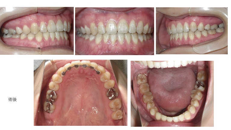 矯正症例80開咬、空隙歯列　能代市　北秋田市　大館市　秋田市