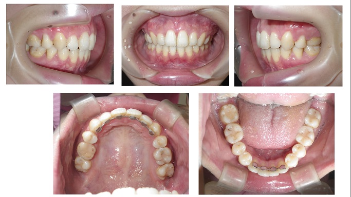 矯正症例70　AngleⅠ級上顎前突、下顎3本切歯症例、他院のやり直し
