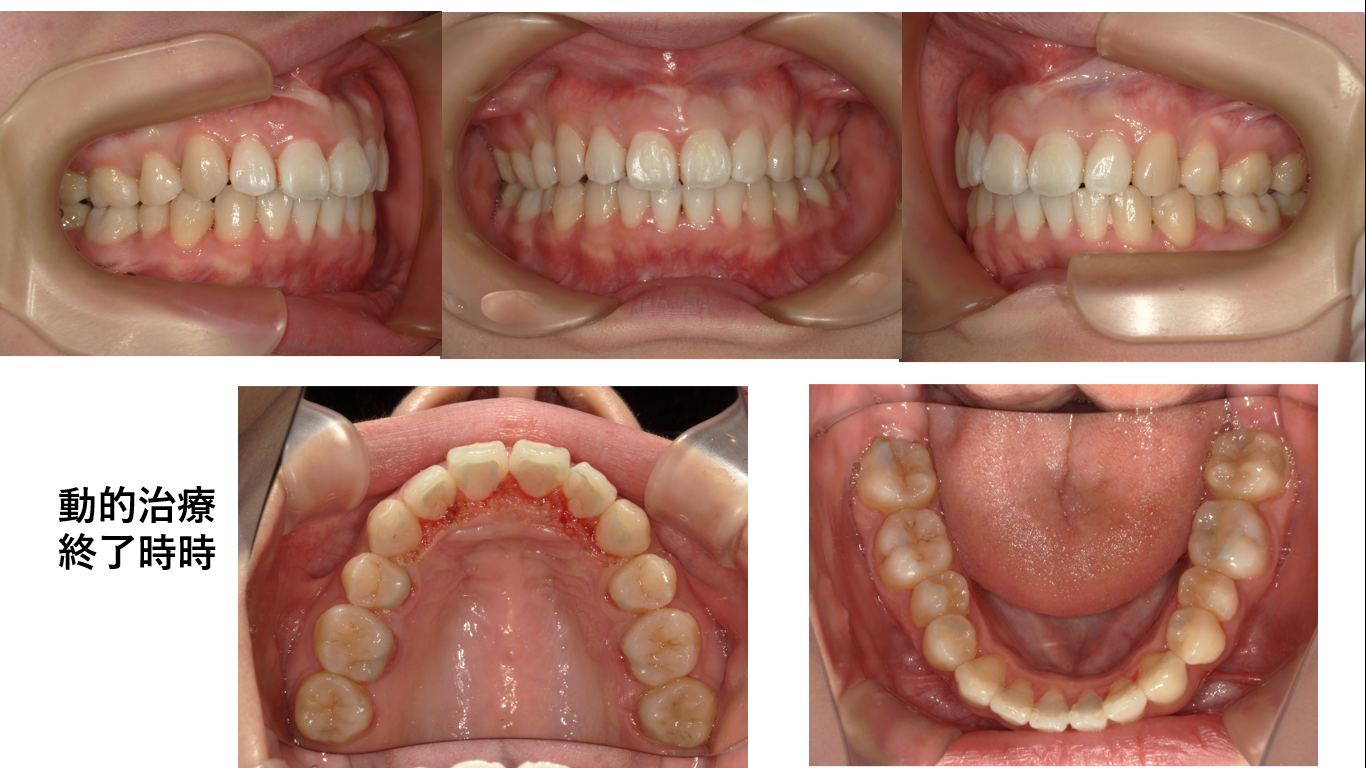 矯正症例147 AngleⅠ級 上顎前突　裏側矯正　舌側矯正