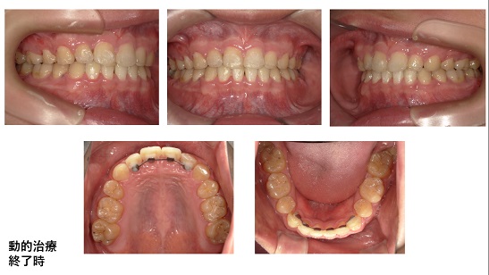 矯正症例84　AngleⅠ級　上顎前突、能代市、北秋田市、大館市、潟上市、秋田市