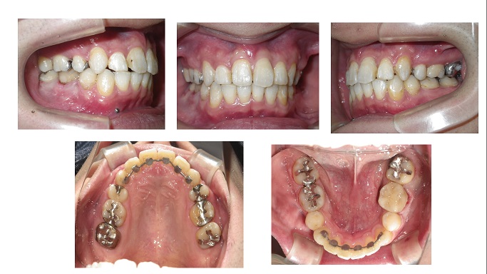 矯正症例59　出っ歯