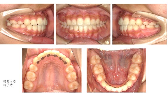 矯正症例89 下顎前突傾向を伴うAngleⅠ級叢生、秋田市、北秋田市、能代市、大館市、潟上市