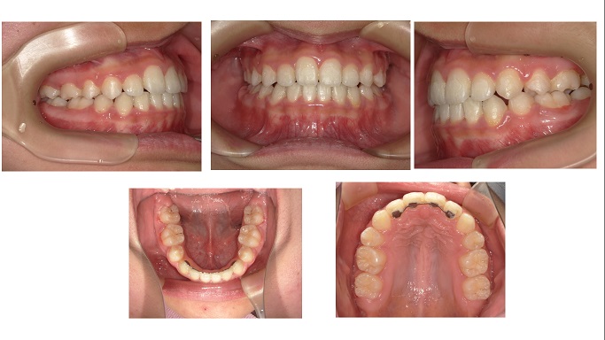 矯正症例75　叢生を伴う骨格性下顎前突