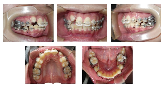 矯正症例７９ 上顎左側2番の先天性欠如を伴うAngleⅡ級1類上顎前突