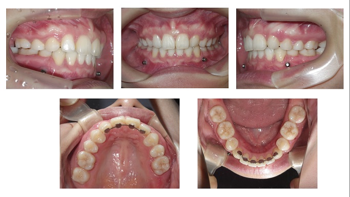 矯正症例69　上顎左側犬歯の先天性欠如を伴う Angle Ⅱ級叢生