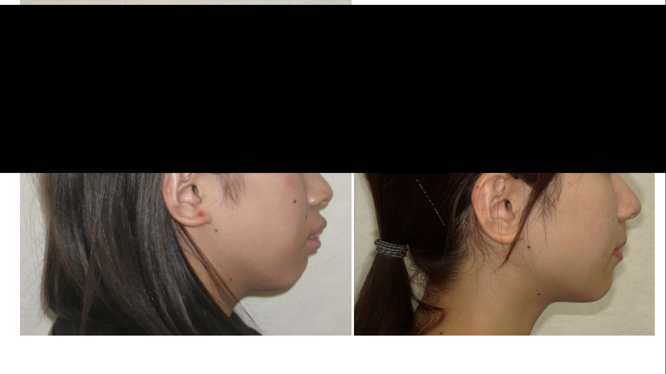 矯正症例138 AngleⅡ級1類 上顎前突