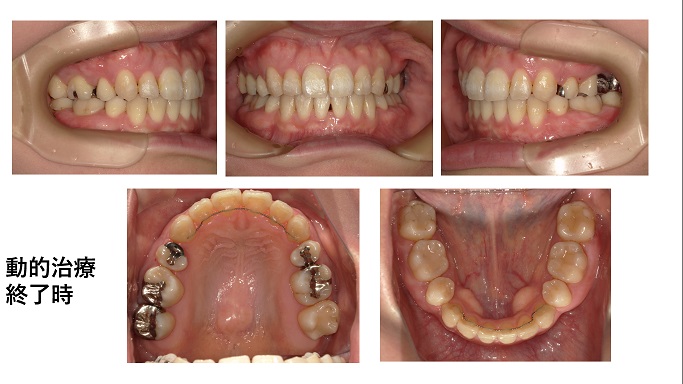 矯正症例100　AngleⅠ級叢生、能代市、北秋田市、秋田市、大館市