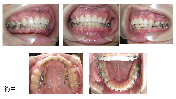 矯正症例82　上顎前突　叢生　ハーフリンガル  裏側矯正 能代市 北秋田市　大館市　北秋田市　潟上市　秋田市
