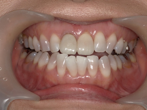 諦めてはいけないテトラサイクリン変色歯のホワイトニングと補綴
