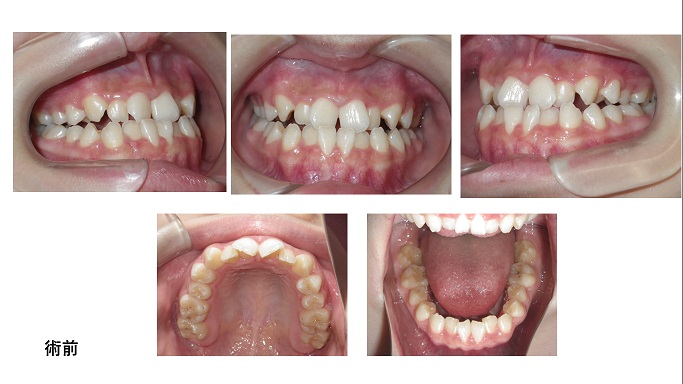 矯正症例74　骨格性下顎前突　カムフラージュ矯正