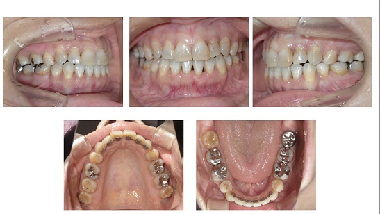 矯正症例55 舌側矯正 ハーフリンガル