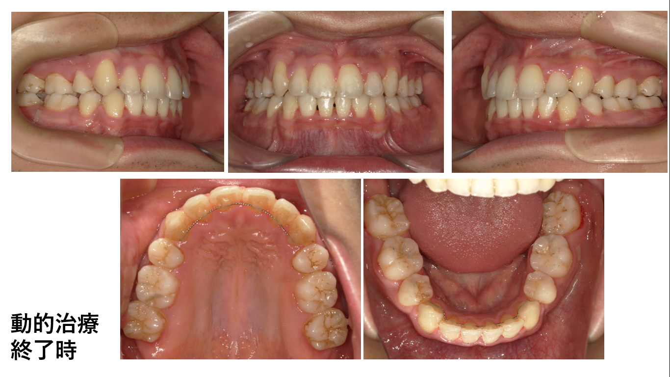 矯正症例102　AngleⅠ級叢生、秋田市、北秋田市、能代市,、大館市
