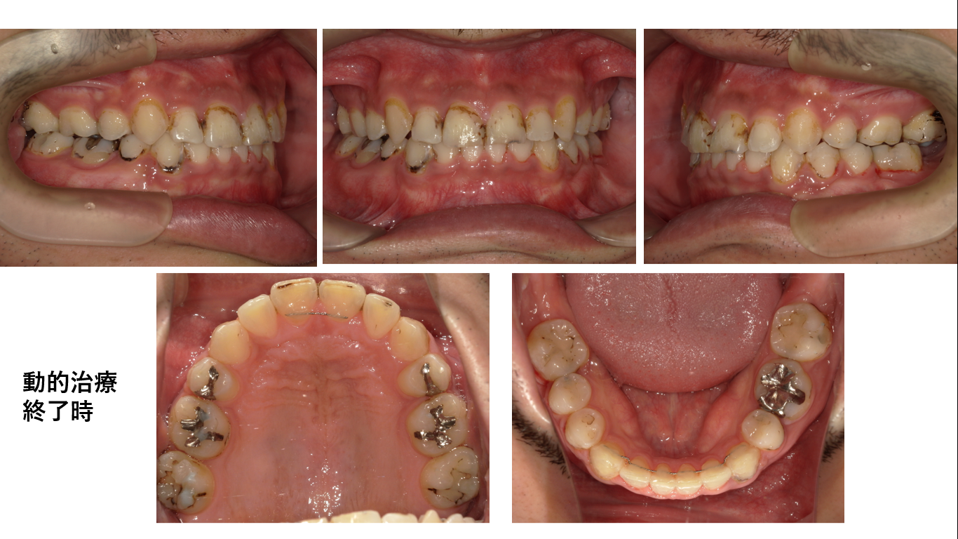 矯正症例146 骨格性下顎前突、八重歯、変則抜歯症例