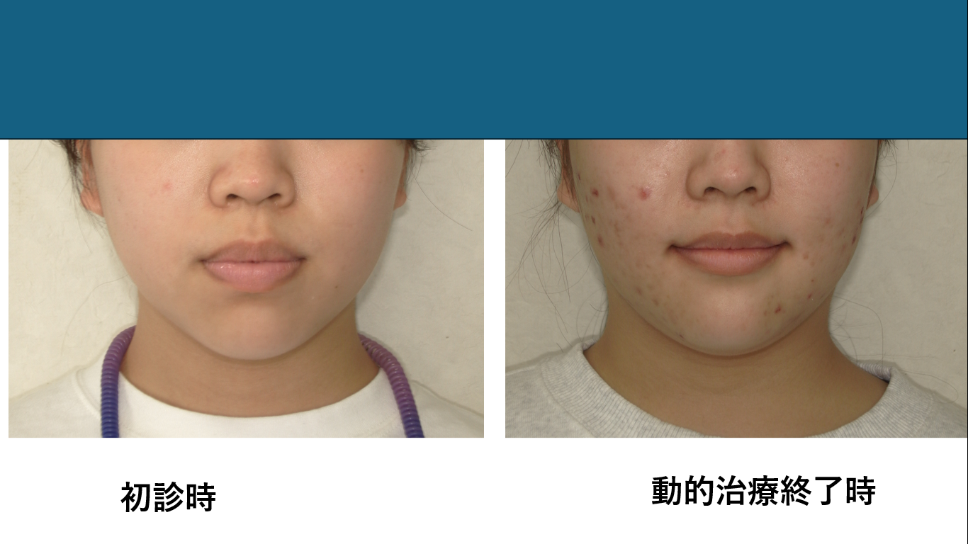 矯正症例141 AngleⅠ級 上下顎前突、ガミースマイル、口ごぼ