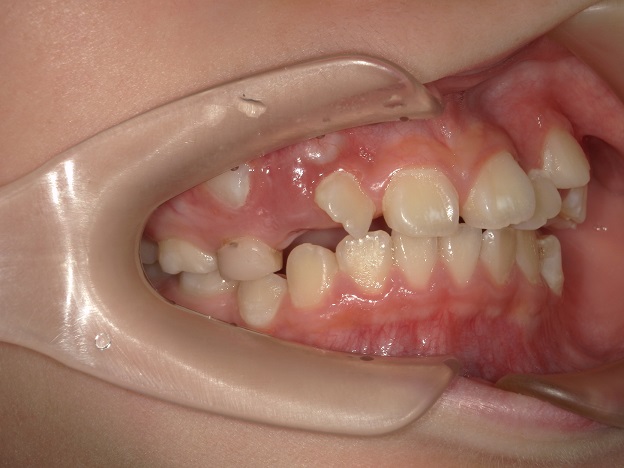 歯列矯正開始時期、子供の矯正は何歳で開始か？9歳で歯列矯正開始？