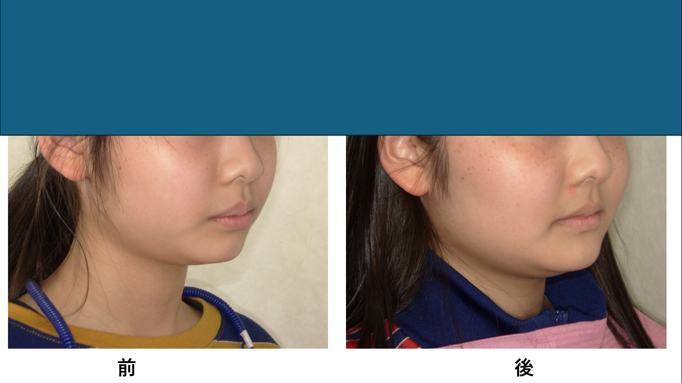 矯正症例149　AngleⅠ級上顎前突