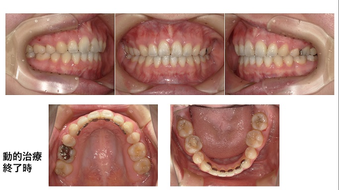 矯正症例77『Angle classⅡ div1 上顎前突』