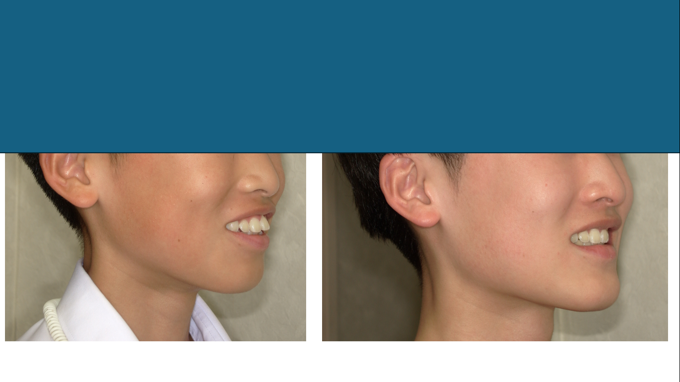 矯正症例148　AngleⅠ級上顎前突、裏側矯正、舌側矯正