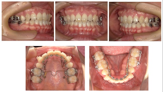 矯正症例81　上下顎前突　裏側矯正 舌側矯正 能代市　北秋田市　大館市　秋田市