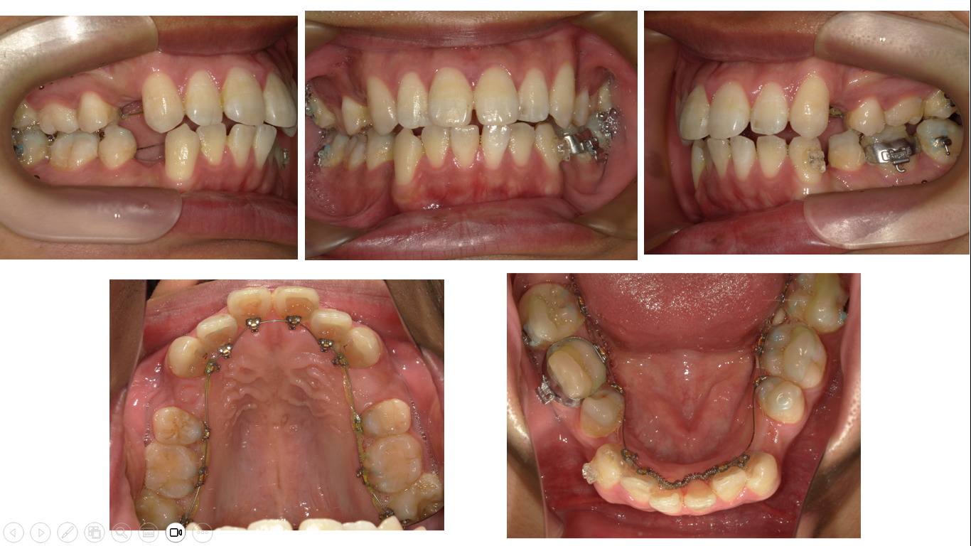 矯正症例 140 AngleⅠ級上下顎前突、舌側矯正