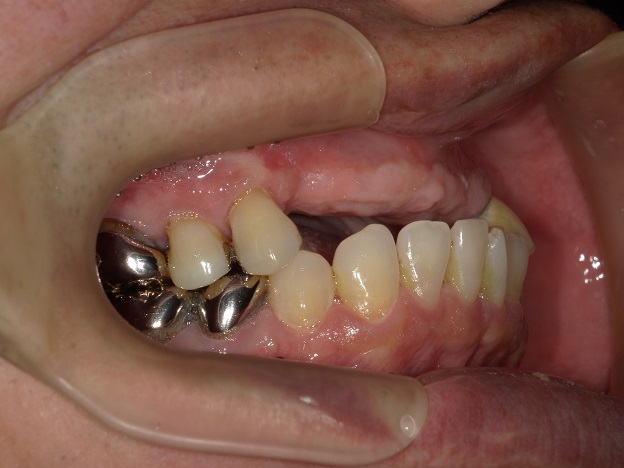 骨格性下顎前突症の上顎前歯インプラント、能代市、北秋田市、大館市