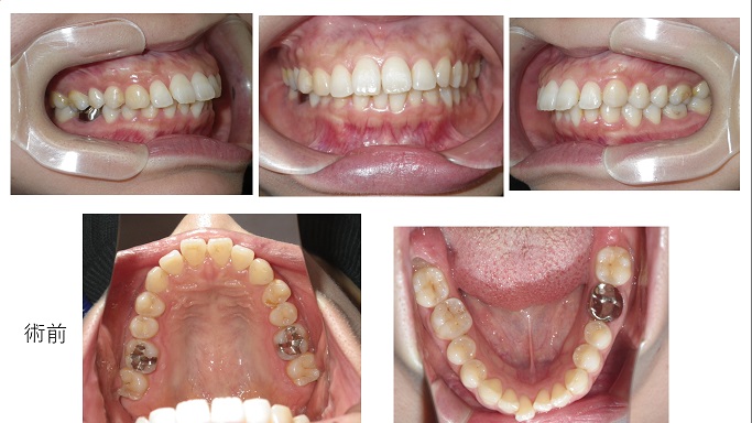 矯正症例86上下顎前突,やり直しの矯正、大館市,北秋田市,能代市、潟上市、秋田市、インチキでたらめ矯正