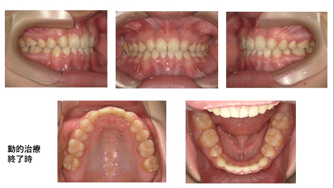 矯正症例97　上顎右側側切歯に先天性欠如を伴う AngleⅠ級叢生、過蓋咬合、秋田市、北秋田市、大館市、能代市