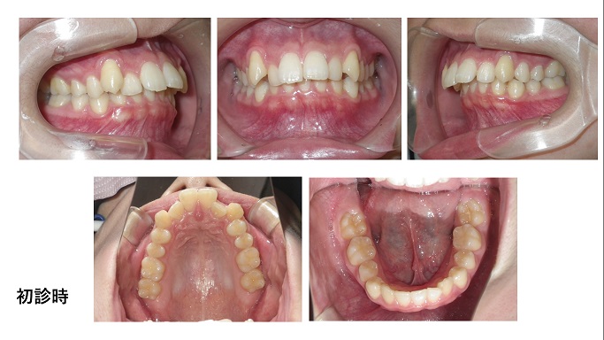 矯正症例76　Angle classⅡdiv１　上顎前突　過蓋咬合　下顎3本切歯症例　