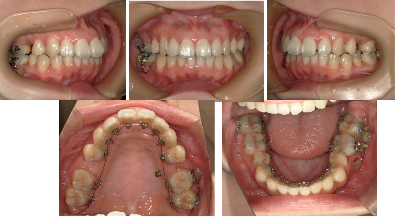 矯正症例147 AngleⅠ級 上顎前突　裏側矯正　舌側矯正